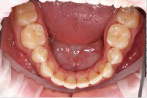 Example: Upper & Lower Arch — Looking into open mouth