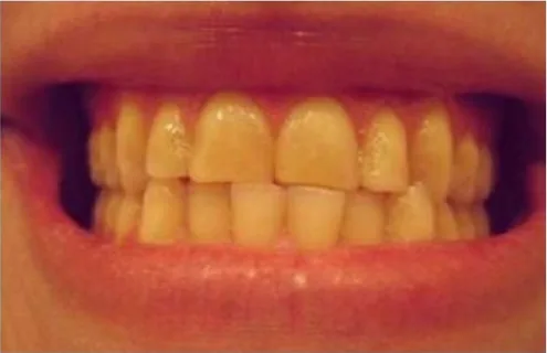 Example: Cross Bite / Side View — Teeth together, side profile