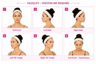 Example: Facelift