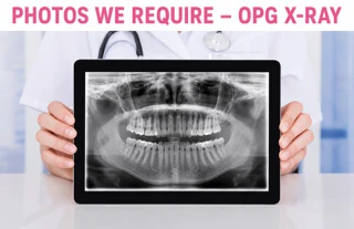 Example: an OPG dental X-ray, the whole jaw in one panoramic image