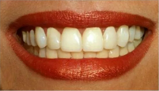 Example: Front Smile View — Natural smile, full face