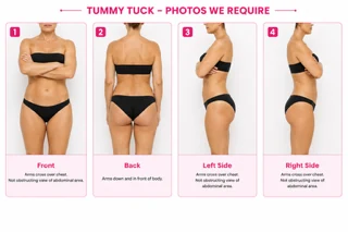 Example: Tummy Tuck