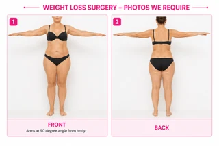Example: Weight Loss Surgery